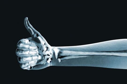 A röntgen segítségével diagnosztizálható az ujjak ízületeiben jelentkező fájdalom