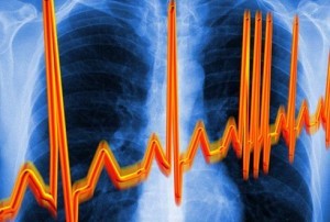 A szívritmus változásai és zavara a nyaki osteochondrosis jele